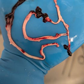 Tom Haviland: A Horrifying Breakthrough in the WHITE FIBROUS CLOT Saga