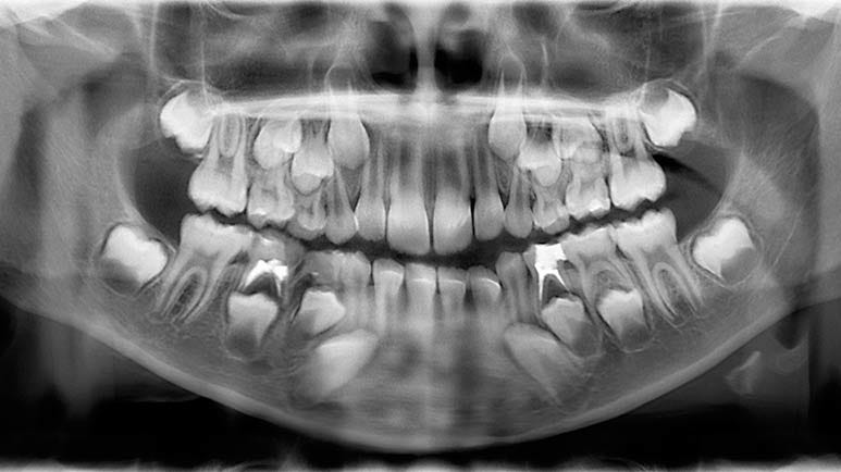 Should Your Child Get That Root Canal?