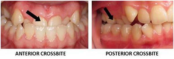 Dental Health....CROSSBITE - Kaieteur News