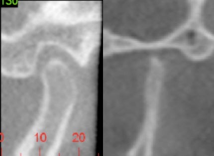 reabsorção óssea condilo toxina botulínica
