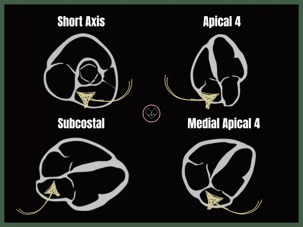 Secundum ASD vs. Patent Foramen Ovale - by Aram K.