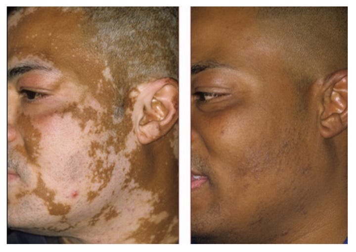 (R) A before and after picture of someone who was light toxic and became light competent under the direction of a decentralized physician.