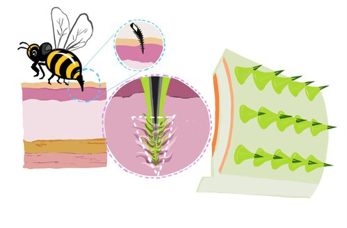 A cartoon of a bee stinging skin and a close-up of the stinger and and microneedles embedded in a patch A cartoon of a bee stinging skin and a close-up of the stinger and and microneedles embedded in a patch