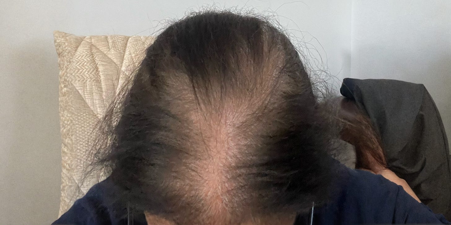 Diffuse Thinning & Hair Loss
