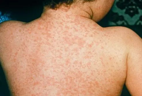 Measles on a child's back.