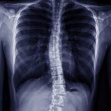 Understanding Scoliosis - Middlesex ... Understanding Scoliosis - Middlesex ...