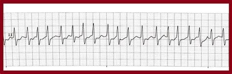 Float Nurse: Various Atrial Fibrillations