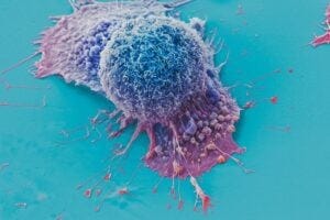 A false color- scanning election micrograph of lung cancer cells grown in culture. A new AI tool called PERCEPTION uses data at the level of single cells to help predict patients’ response to different therapies.
