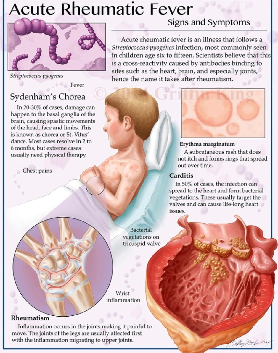Beyond the Sore Throat: The Hidden Threat of Rheumatic Fever