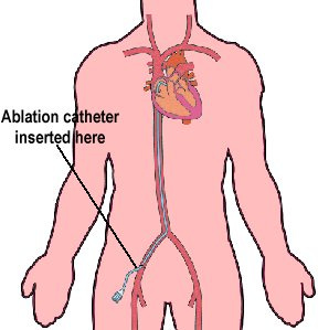 AFIB Mini-Maze : Arrhythmia Surgery