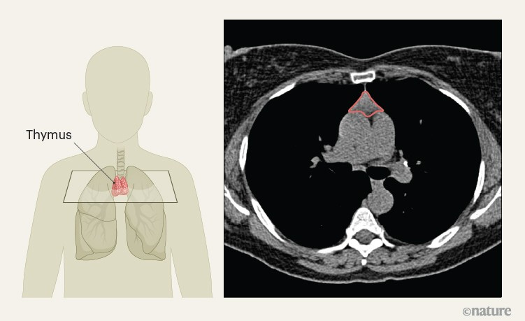 Figure 1; Left panel: A diagram of a human showing the position of the thymus relative to the lungs; Right panel: An image of a CT cross-section through the body showing the position of the thymus.