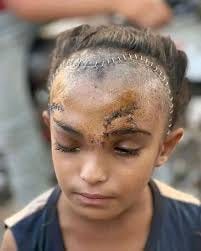 Emily Henochowicz an American Jewish Pro-Palestine activist lost her eye  from an Israeli tear gas canister! She was rescued by Palestinians!