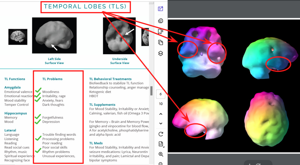 SPECT Brain Scans prepared by the Amen Clinics.