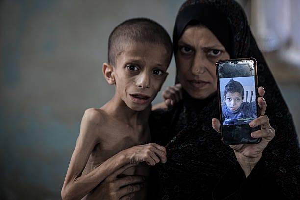 Year-old Nafez Mohammed Khidr Nasser struggles with serious health issues due to malnutrition and brain atrophy in Gaza City, Gaza on August 05,...