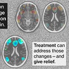 Interview: How brain stimulation can treat depression