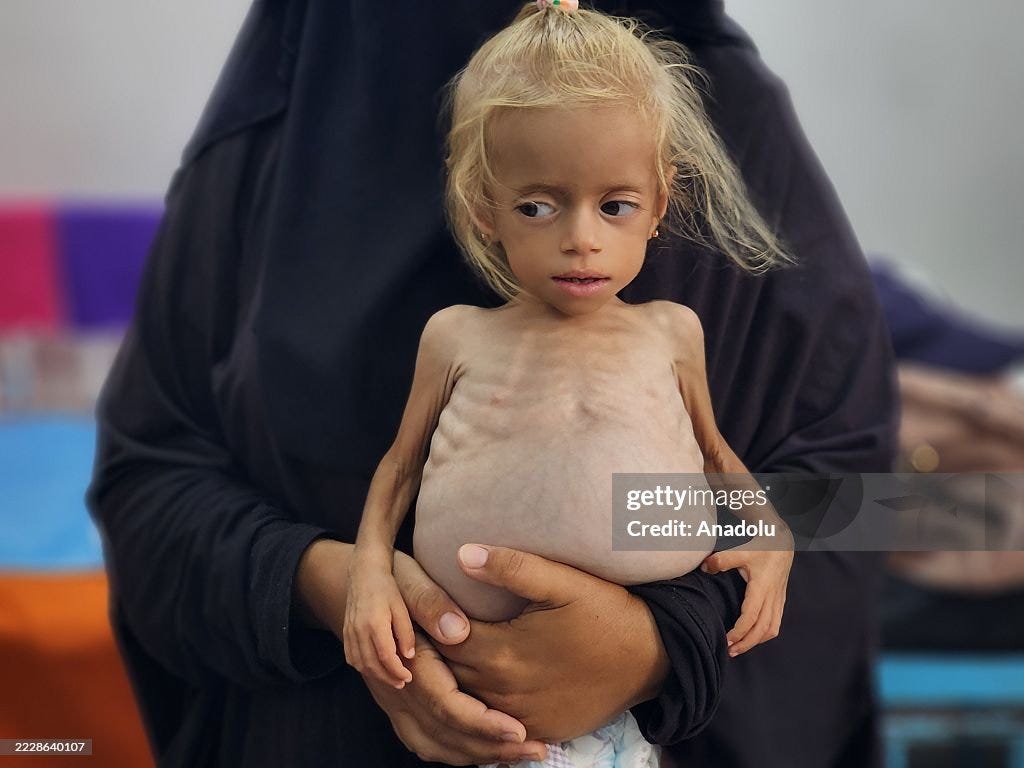 Children suffering from malnutrition in Gaza receive treatment under limited conditions