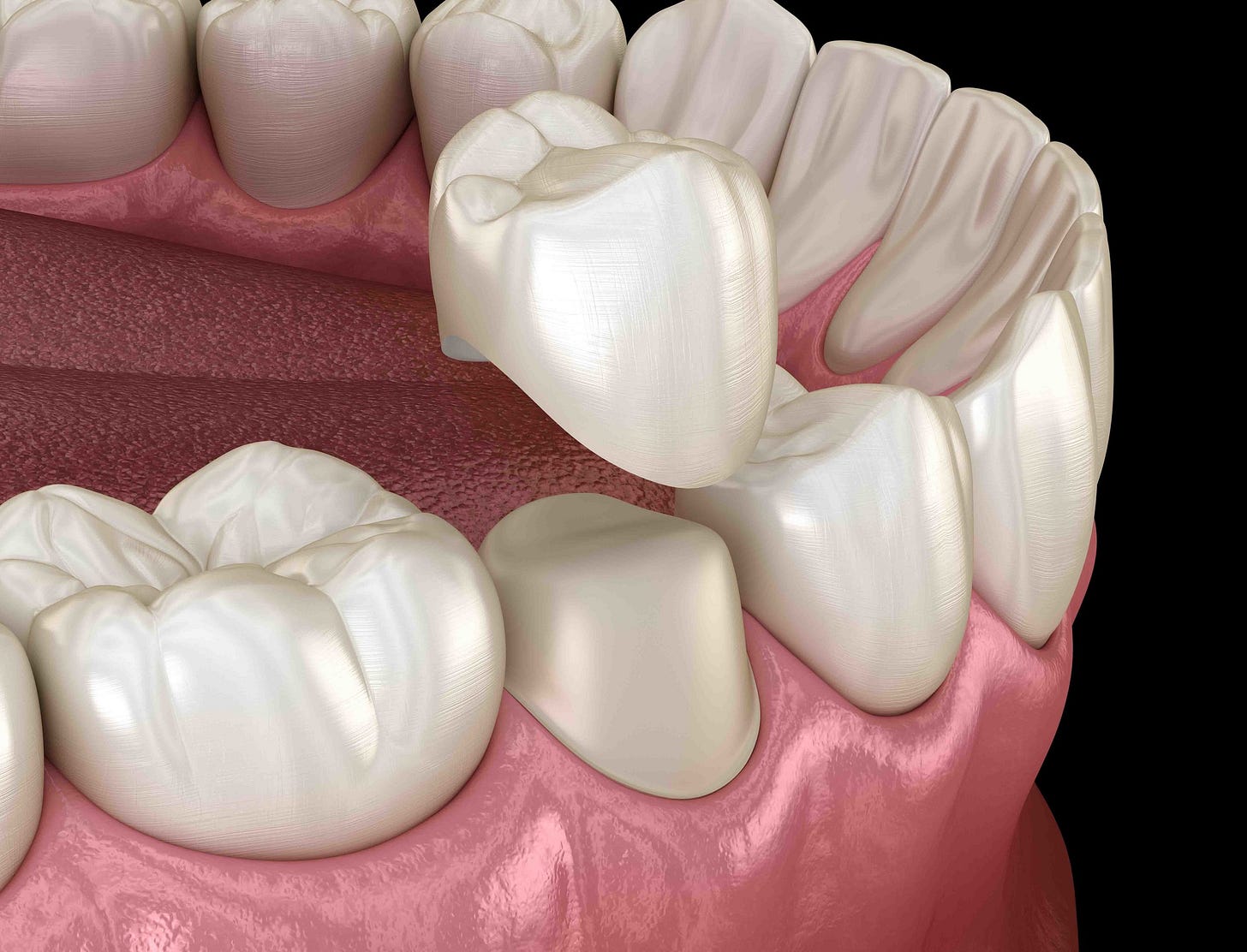 Crowns, Bridges and Veneers in Hoppers Crossing — Hogans Road Dental |  Hoppers Crossing & Werribee Dentist since 1988
