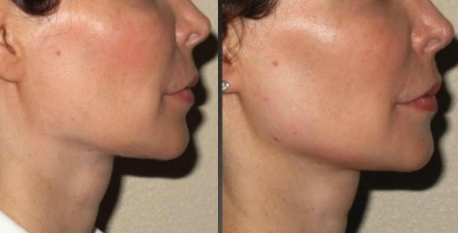 Where does Radiesse go when it “fades”? : r/PlasticSurgery