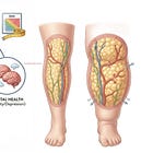 Am I Making My Lipedema Worse?