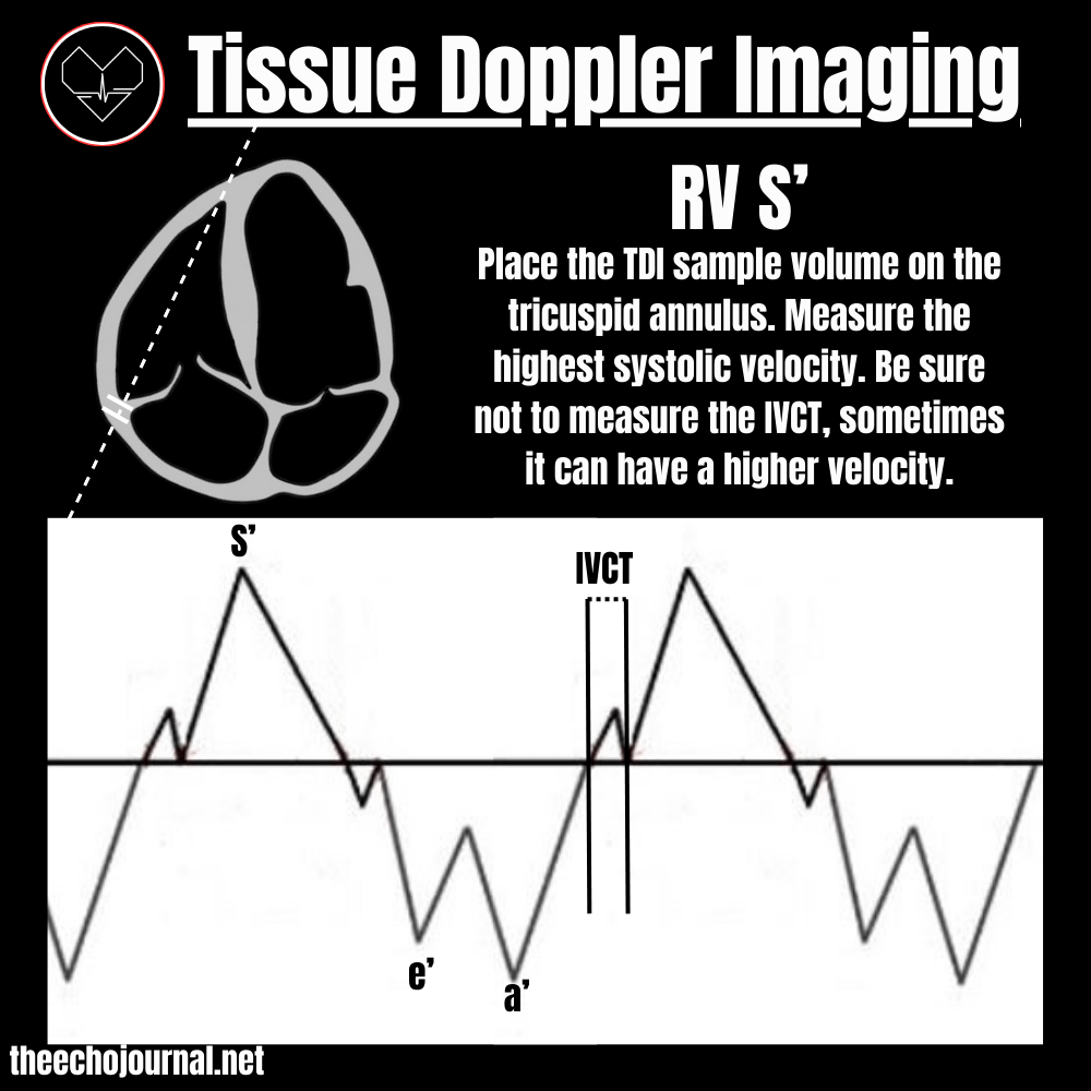 The Right Ventricle Made Easy! - by Alex C.