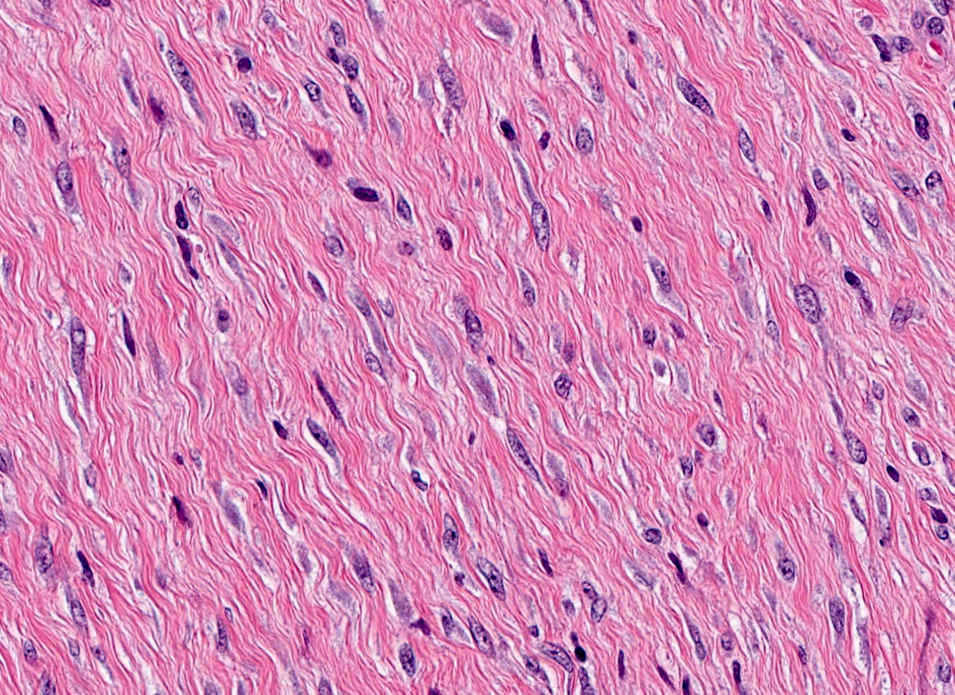 Bland spindle cells Bland spindle cells