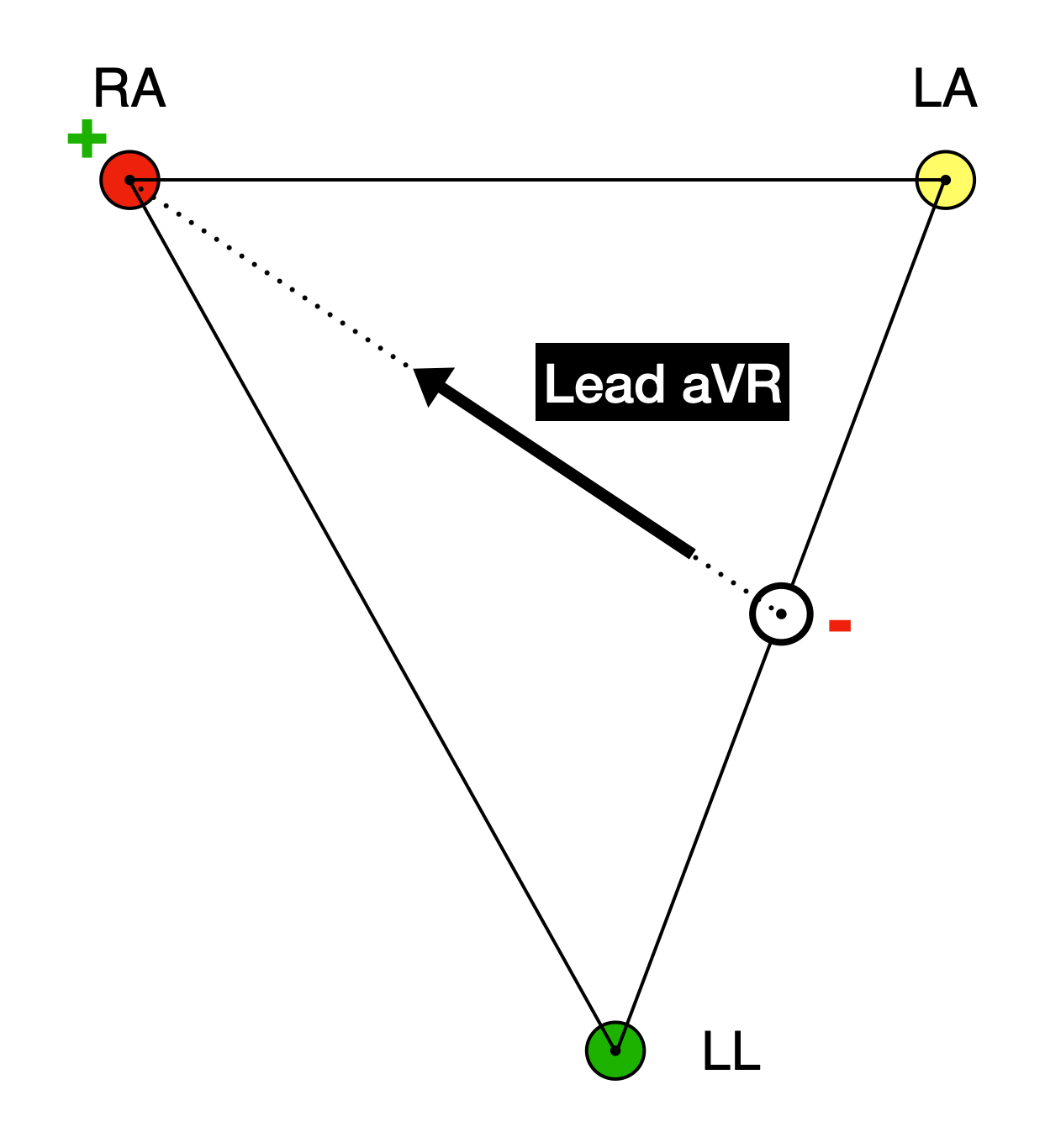 Einthoven's triangle with RA (red), LA (yellow), and LL (green) at the vertices. A small hollow circle sits on the side connecting LA and LL, at its midpoint, marked with a red minus sign. A black arrow runs from this midpoint up to the RA electrode, which is marked with a green plus sign. The arrow is labelled Lead aVR.