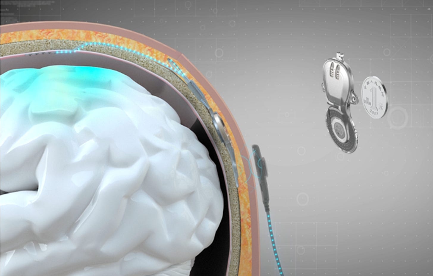 Minimally Invasive Brain Computer Interface helps tetraplegia restore hand  functions-Tsinghua University