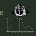 Left Atrial Strain Explained