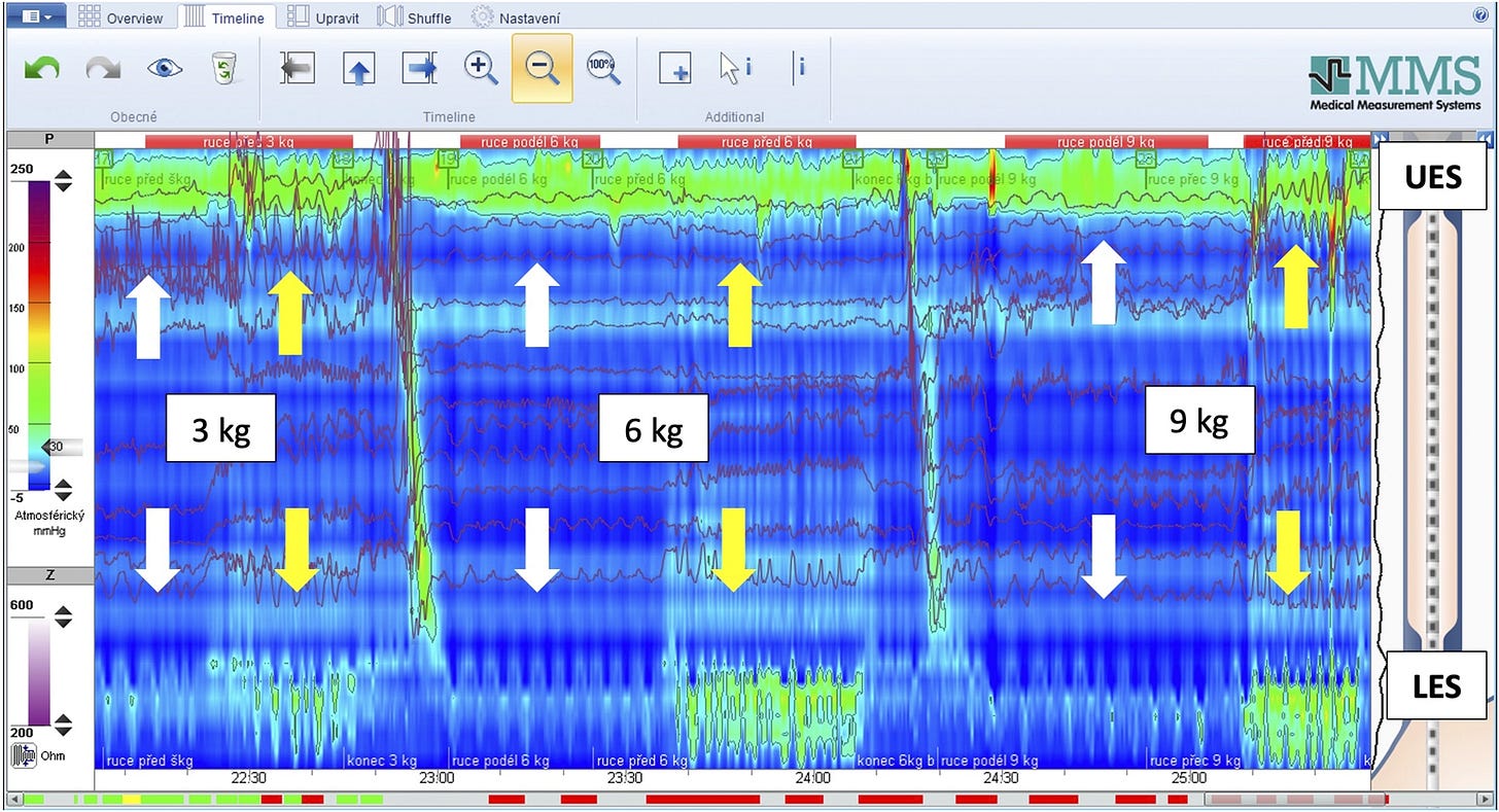 Bản ghi áp lực đo bằng manometry độ phân giải cao, thể hiện vùng áp lực cao tại chỗ nối thực quản–dạ dày (LES/HPZ) khi so sánh hai vị trí tay trong nghiên cứu Bitnar và cộng sự năm 2026.