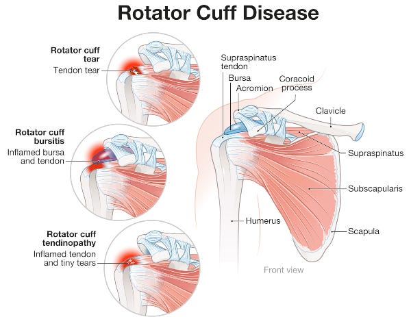 Shoulder Pain and the Rotator Cuff » OrthoGeorgia