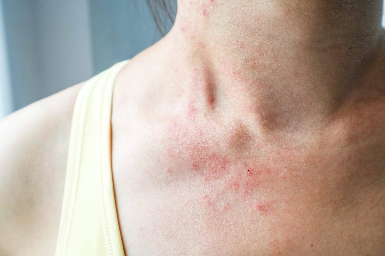 Rash cutaneo da farmaci: Cure, Rimedi e Cosa Fare!