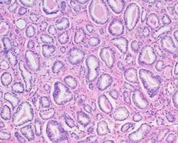 Is Gleason 6 really cancer? - BJUI