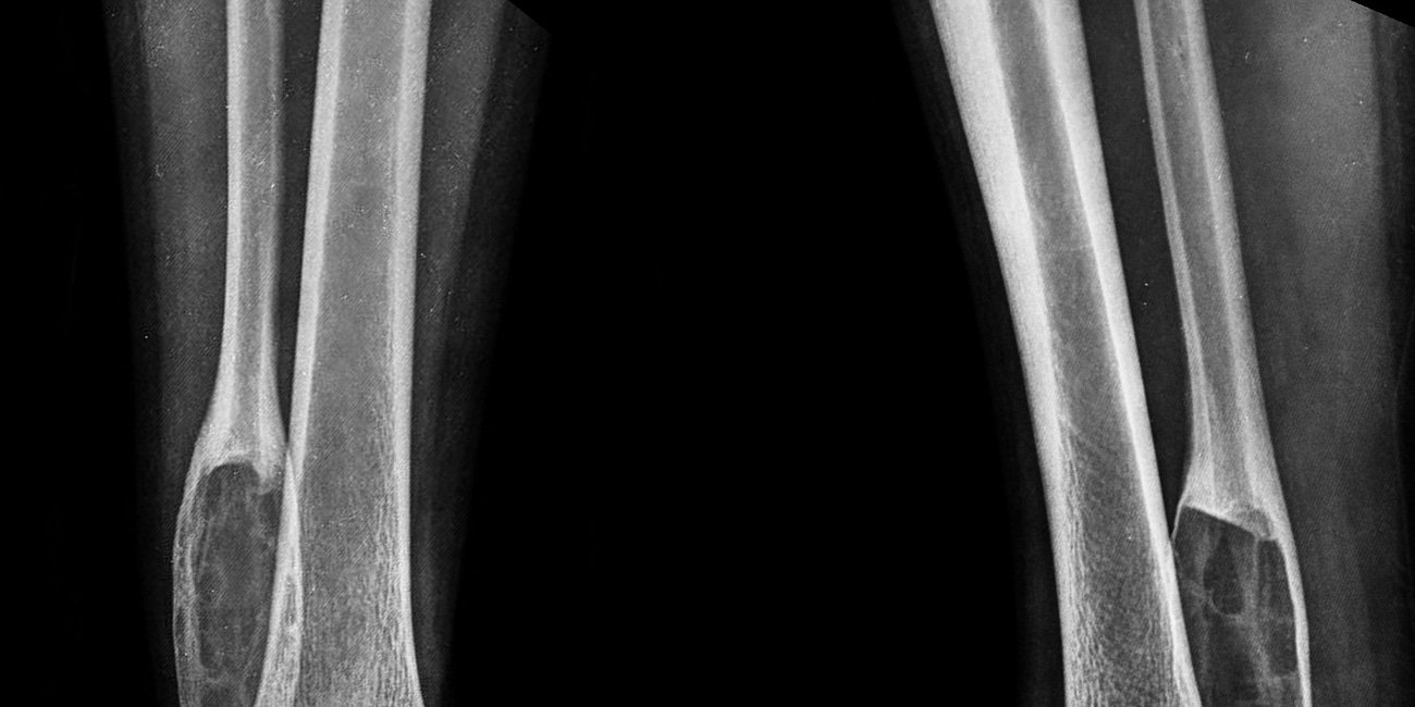 Case 66: Solid-Variant Aneurysmal Bone Cyst (ABC)