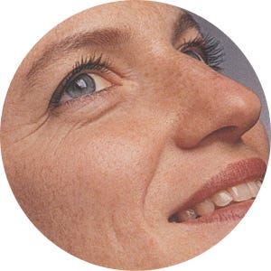 Exemplo de envelhecimento classificado como Glogau tipo II