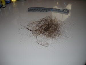 iodine for hair loss