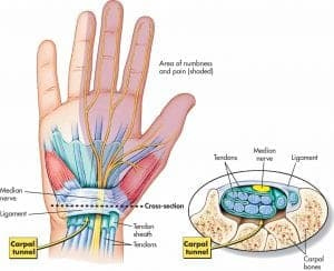 Carpal Tunnel Syndrome - Mississauga Pain Clinic