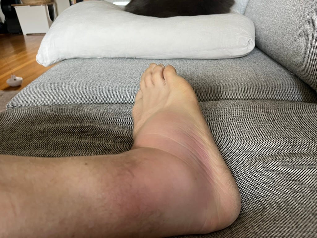 Bruised and swollen ankle