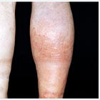 What is a D-Dimer Test? "We avoided an emergency last week."