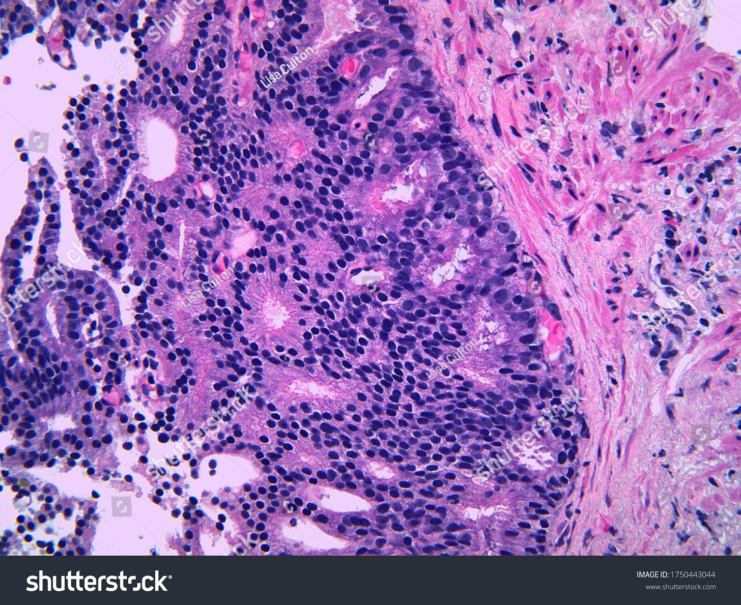 Detail Prostate Cancer Cribriform Glands Which