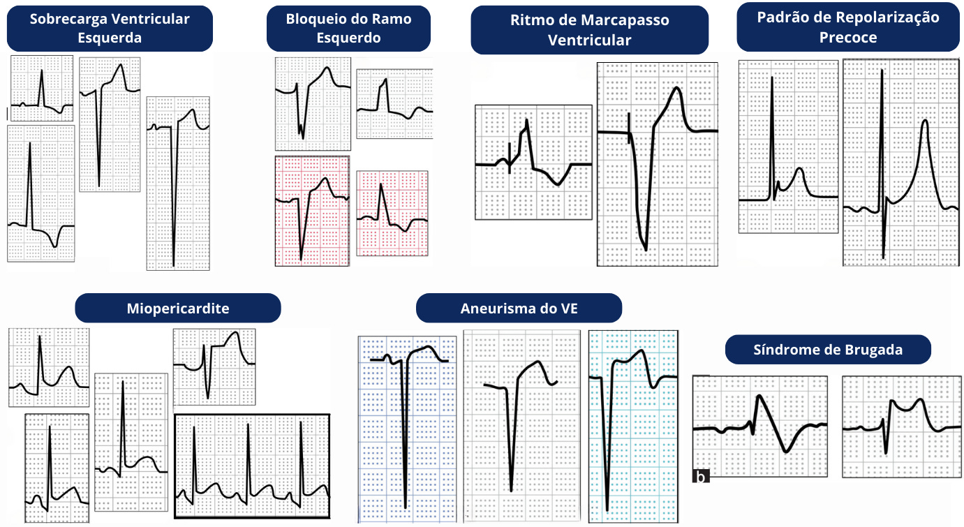 Você sabe interpretar a ONDA T no eletrocardiograma? A onda T é um  componente importante do ECG que fornece informações valiosas sobre a  função elétrica do coração. Alterações na onda T podem, image size:1381x755