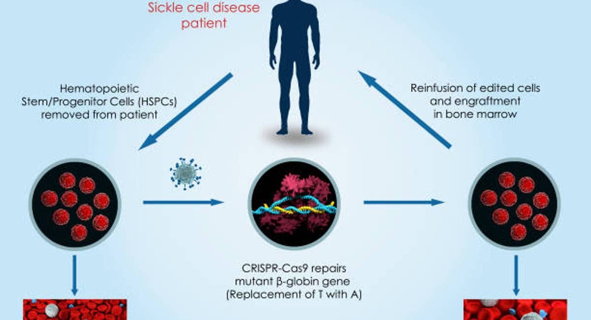Sickle Cell Disease And The Era Of CRISPR