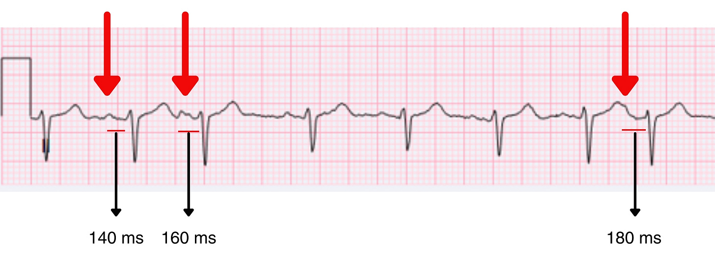 Multifocal Atrial Rhythm: variable P wave morphology