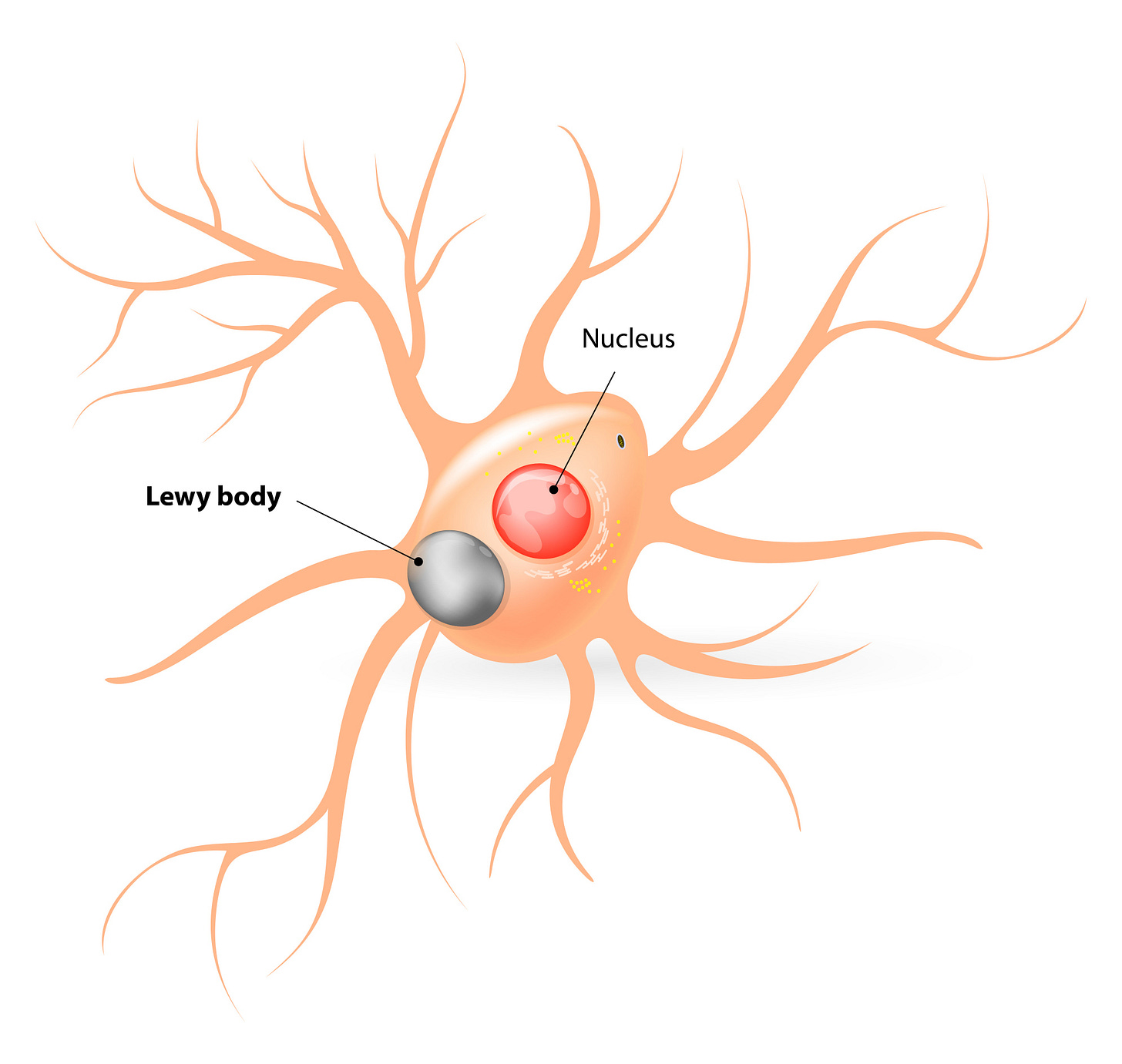 Image of Lewy bodies in brain neurons