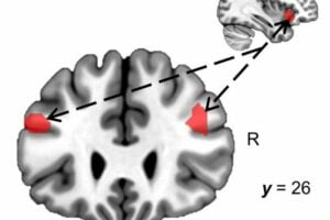 This fMRI image of the human brain shows how cognitive fatigue strengthens the connection between the insula (shown in the smaller image) and the dorsolateral prefrontal cortex (larger image).