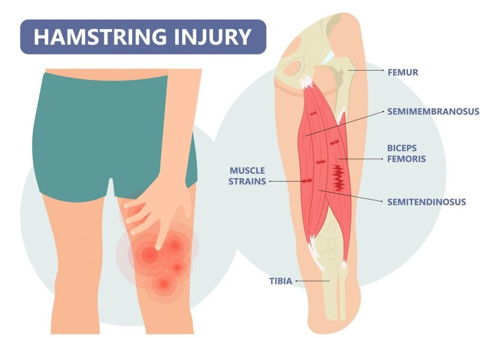 Hamstring Strain in Singapore