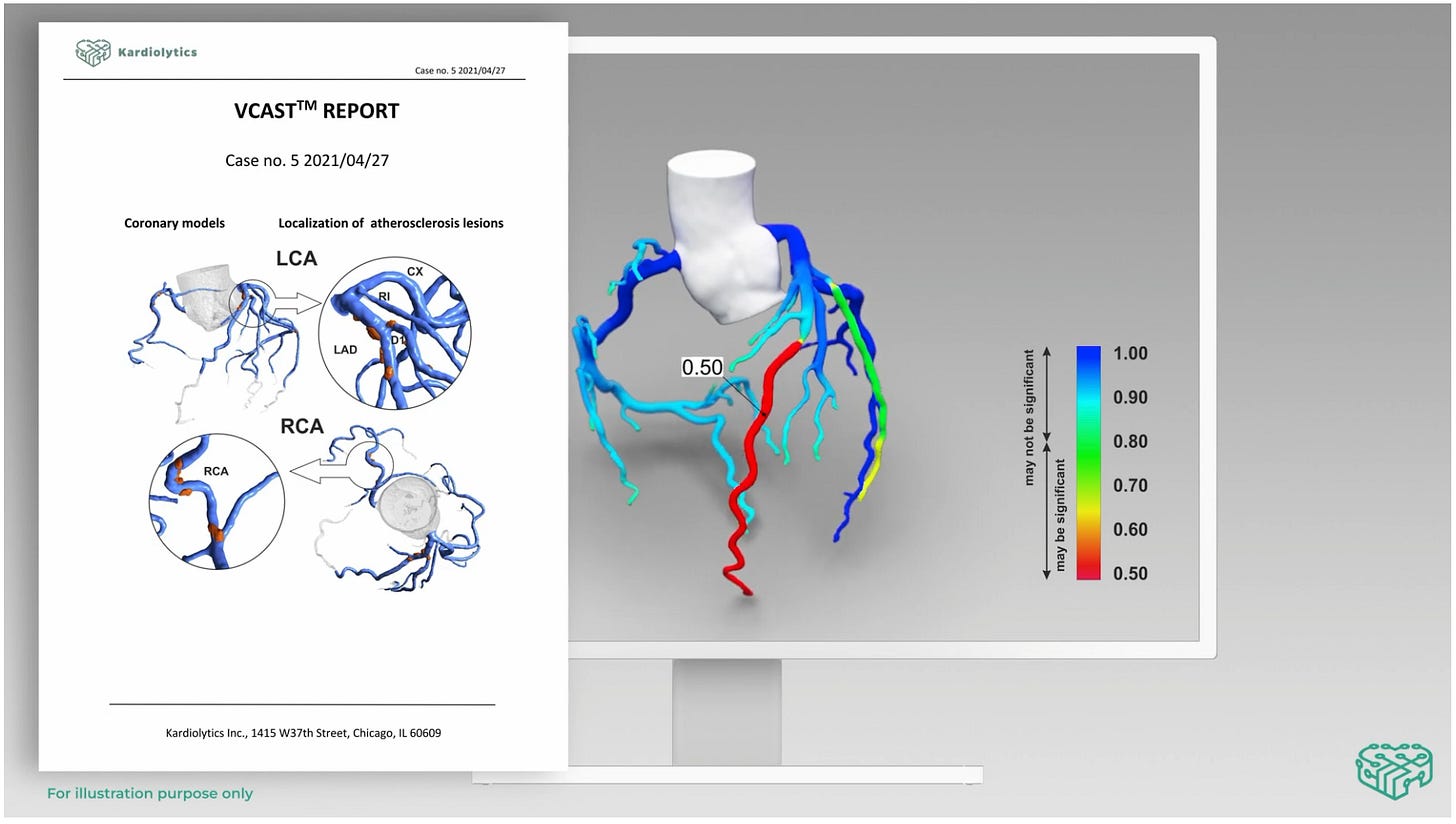 Kardiolytics - The Virtual Cardiac Stress Test (VCAST) Kardiolytics - The Virtual Cardiac Stress Test (VCAST)