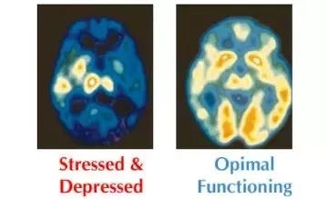 Can damage caused by extreme stress be seen in a brain scan? - Quora