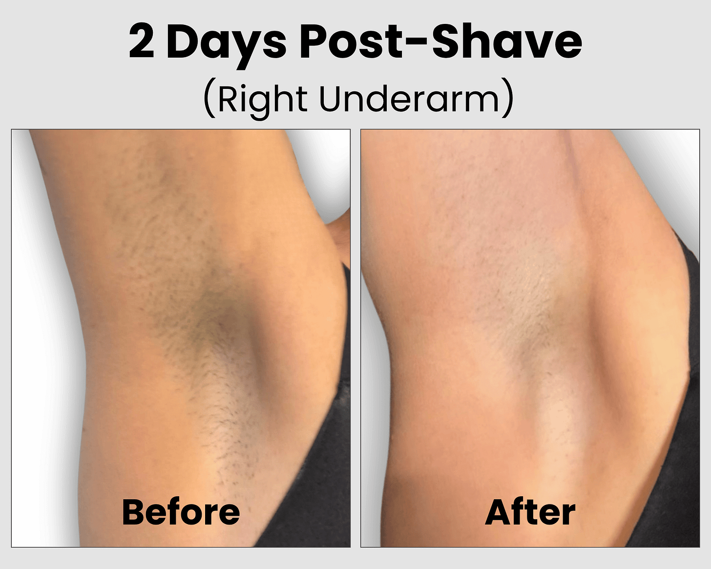Ulike Air 10 Before and After Results on Fitzpatrick II and III Skin Right Underarm