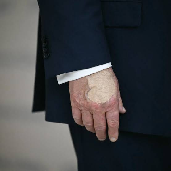 What Trump's hand bruise signifies, explained by vascular surgeons | STAT