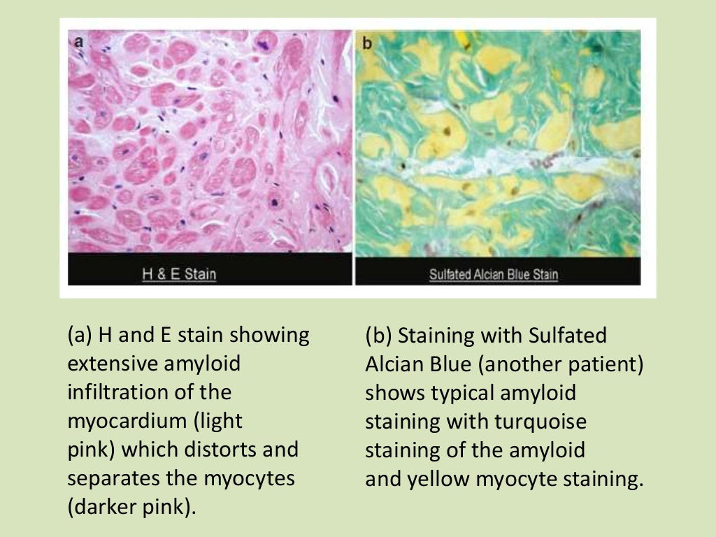 Cardiac Amyloidosis